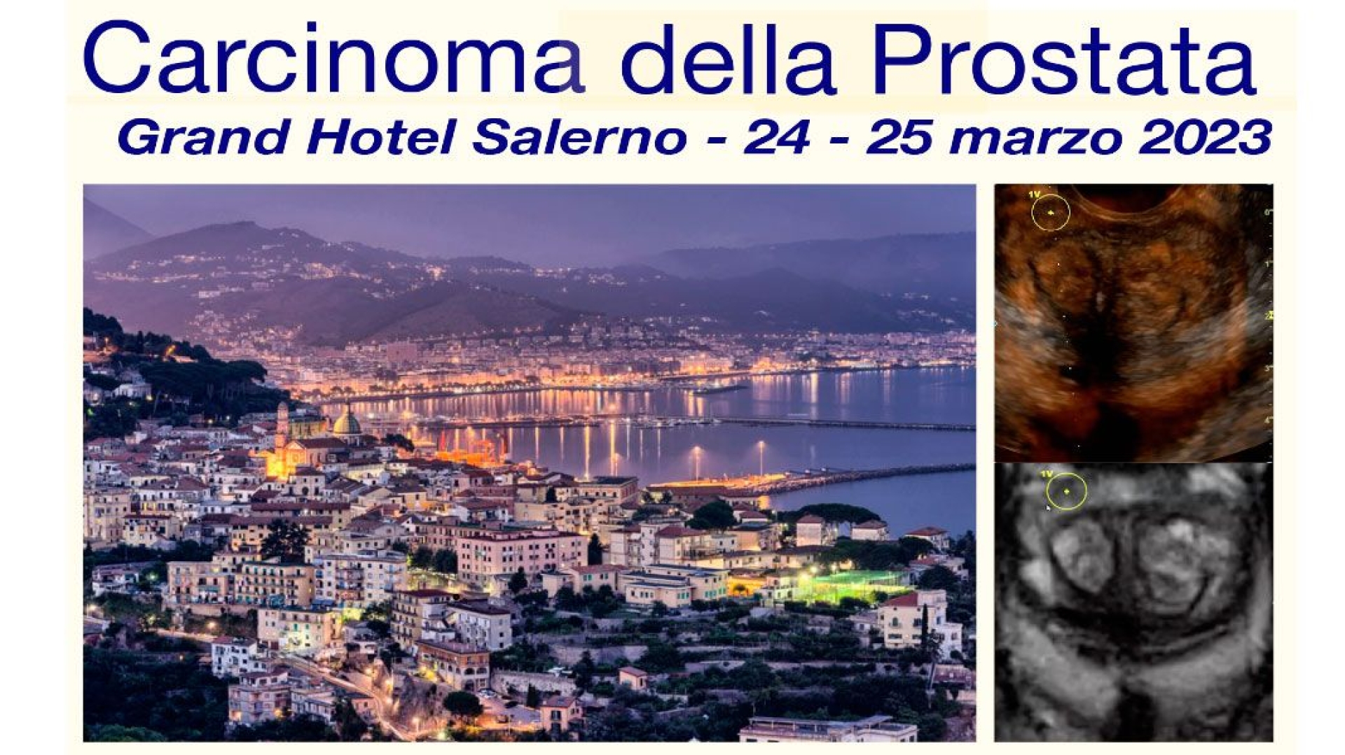 II Corso Interattivo sul Carcinoma della Prostata