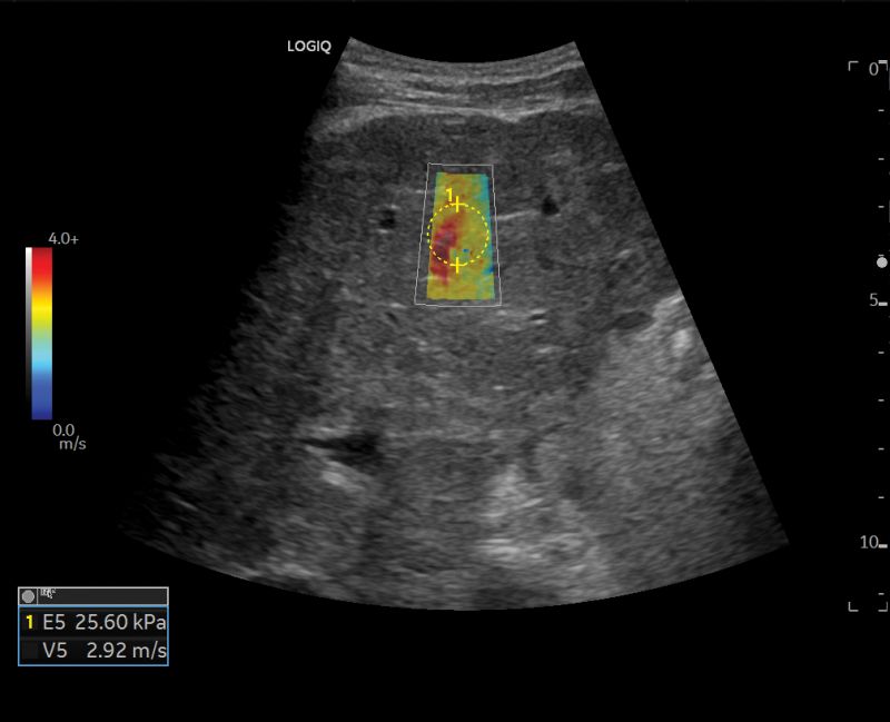 elastografia 2D Shear Wave e Strain