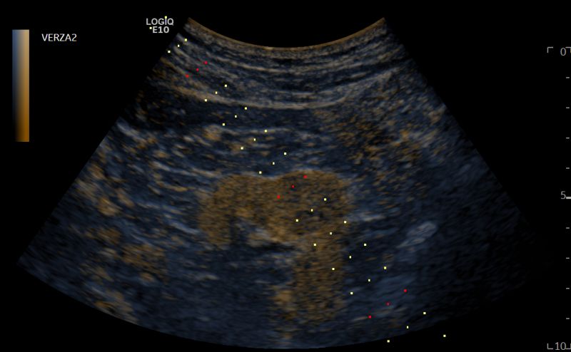 Ecografia con mezzo di contrasto (CEUS)