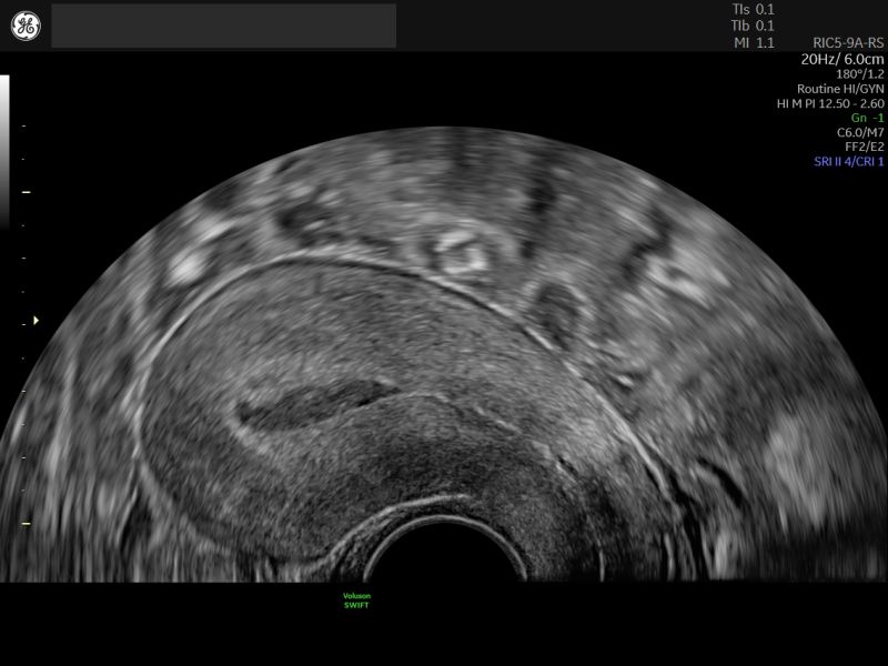 Ematometra