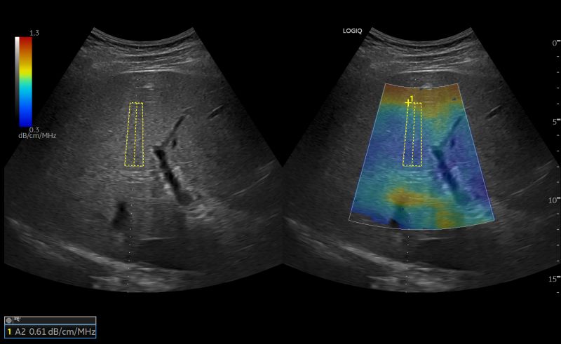 Elastografia Shear Wave 2D