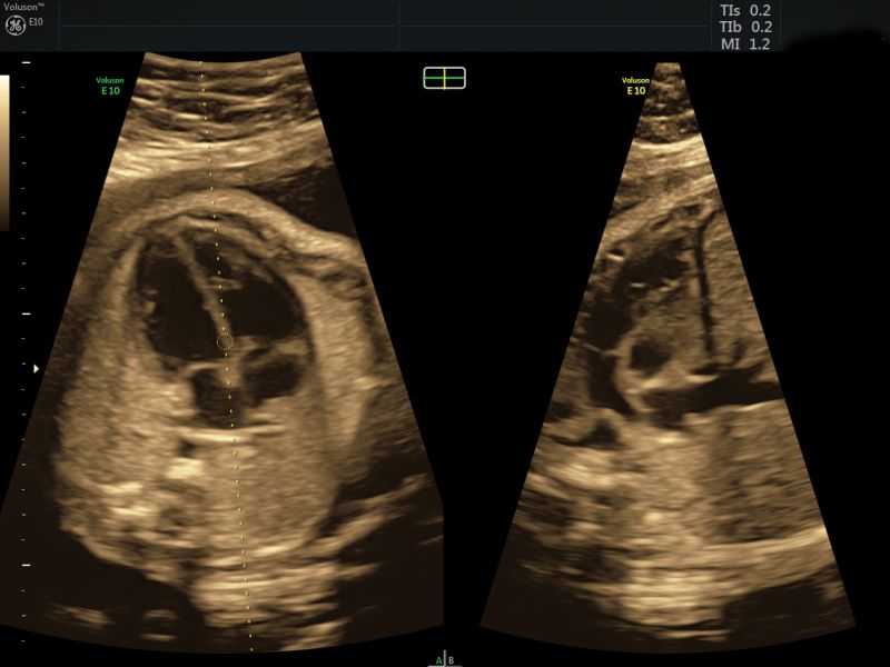 Imaging biplanare