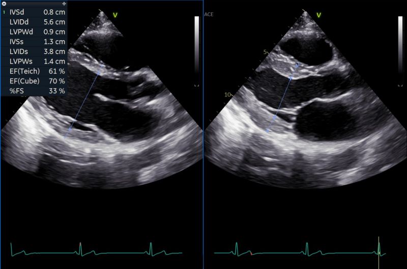 Quantificazione delle camere cardiache