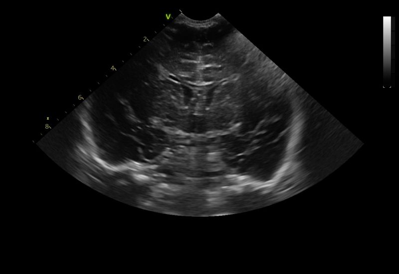 Ecografia encefalica neonatale
