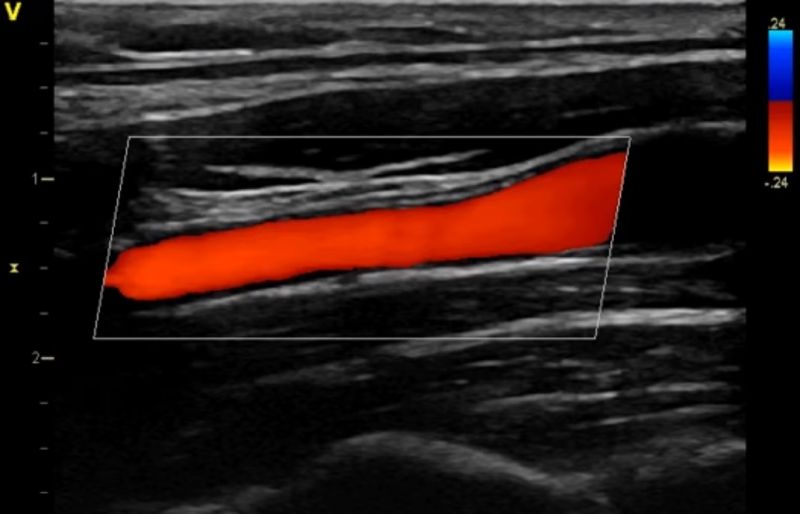 Blood Flow Imaging