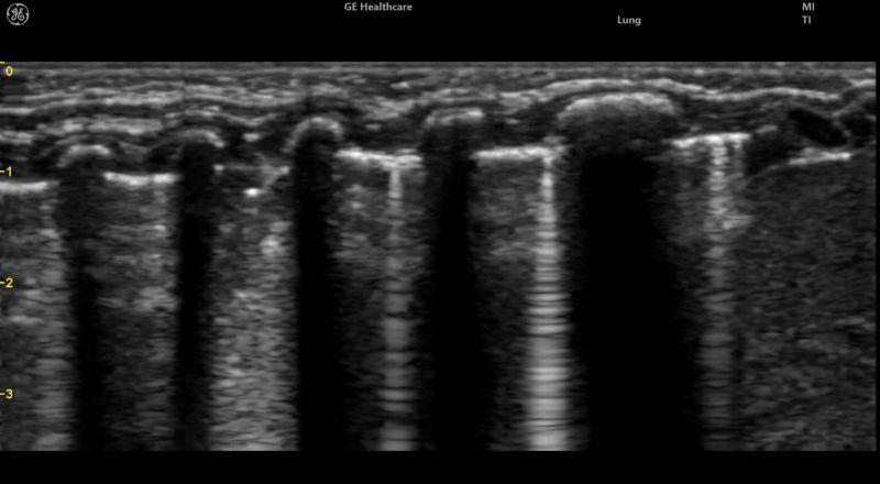 Visualizzazione rapida dell’intero polmone | Lung Sweep