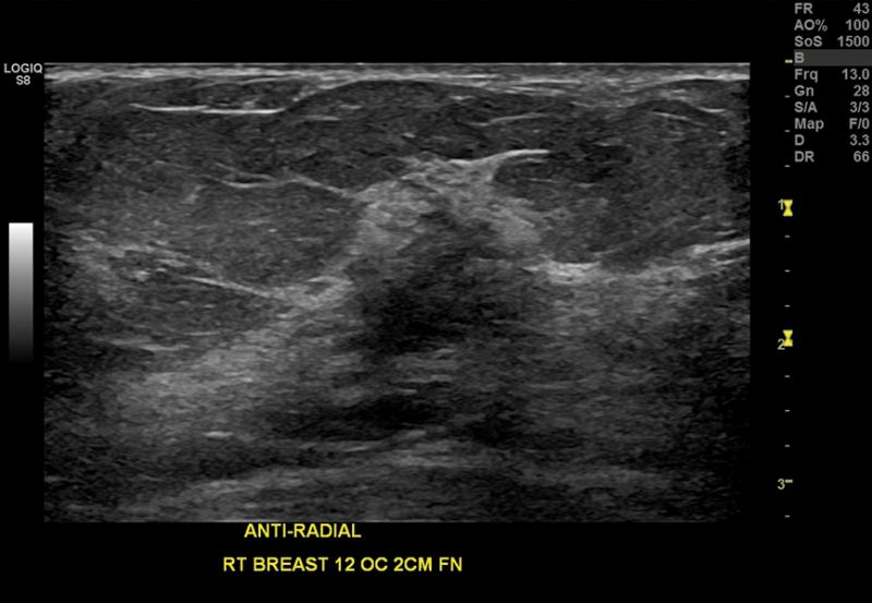 Imaging B-Flow potenziato con B-Flow HD Color