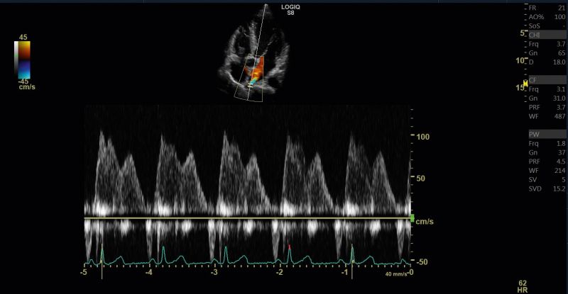 Imaging potenziato con mezzi di contrasto (CEUS)