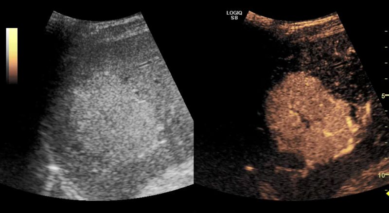 Imaging con mezzi di contrasto potenziato (CEUS)