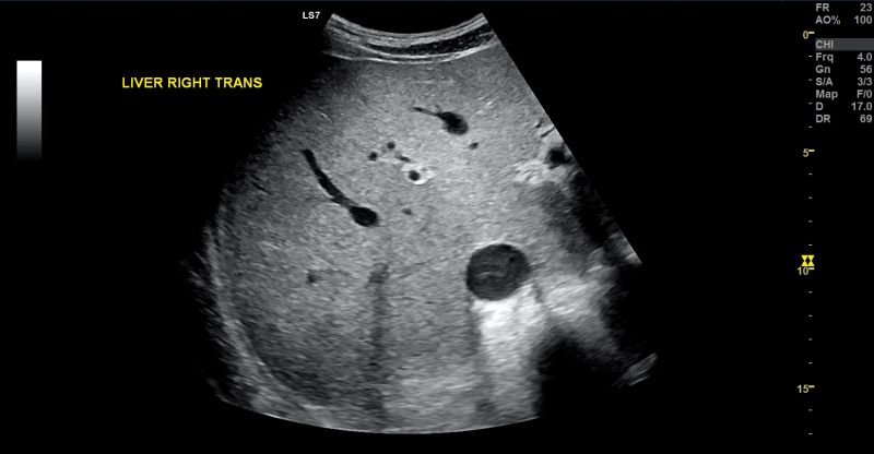 Elastografia Shear Wave 2D