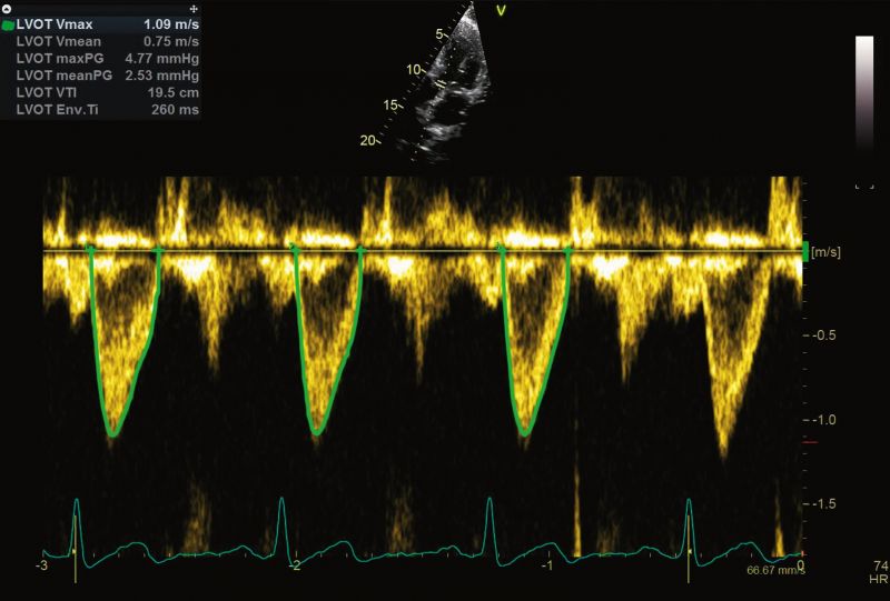 Cardiac Auto Doppler